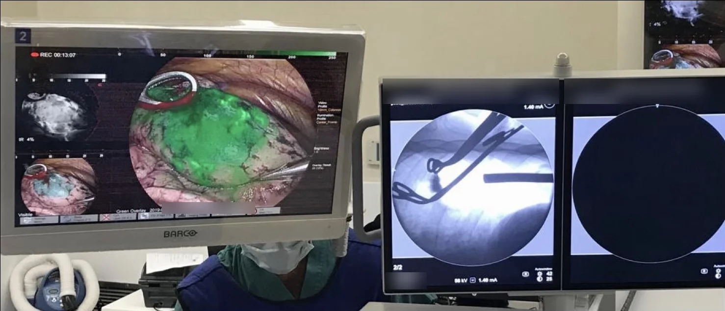 Monitores en el pabellón: a la izquierda, la visión con fluorescencia en infrarrojo cercano muestra en verde el verde de indocianina sobre el pulmón; a la derecha, la radioscopia