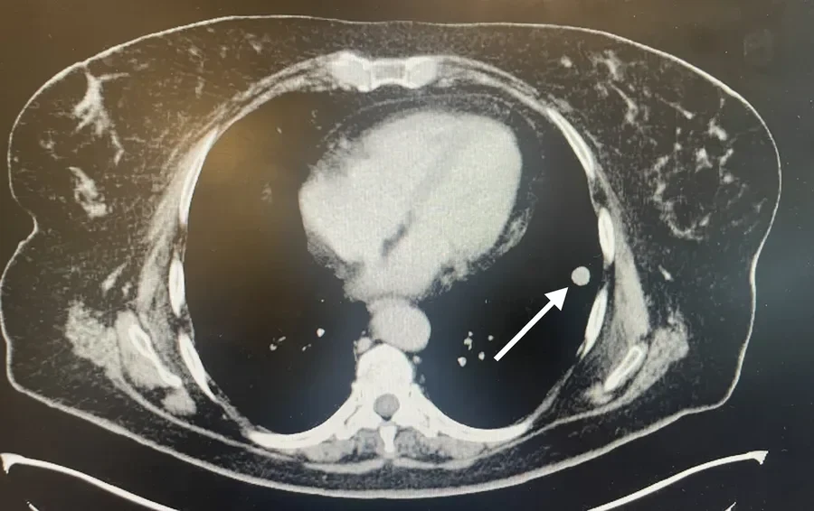 TAC de tórax con un nódulo pulmonar antes de la marcación