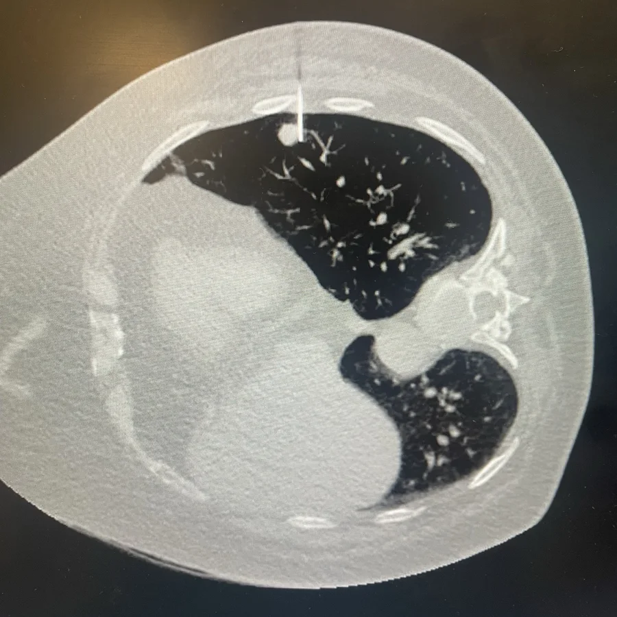 TAC de tórax con una aguja fina dirigida al nódulo pulmonar