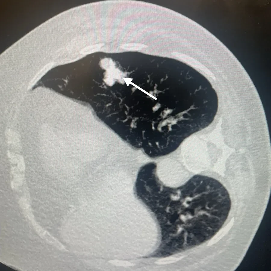 TAC de tórax con lipiodol depositado en el nódulo pulmonar